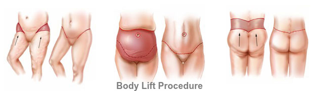 AmazeMedSpa - Total Body Lift, Belt Lipectomy Surgery in Guntur