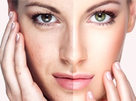 skin_whitening_treatment