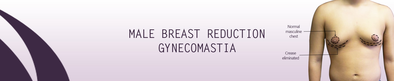 gynecomastia_surgery