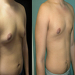 gynecomastia