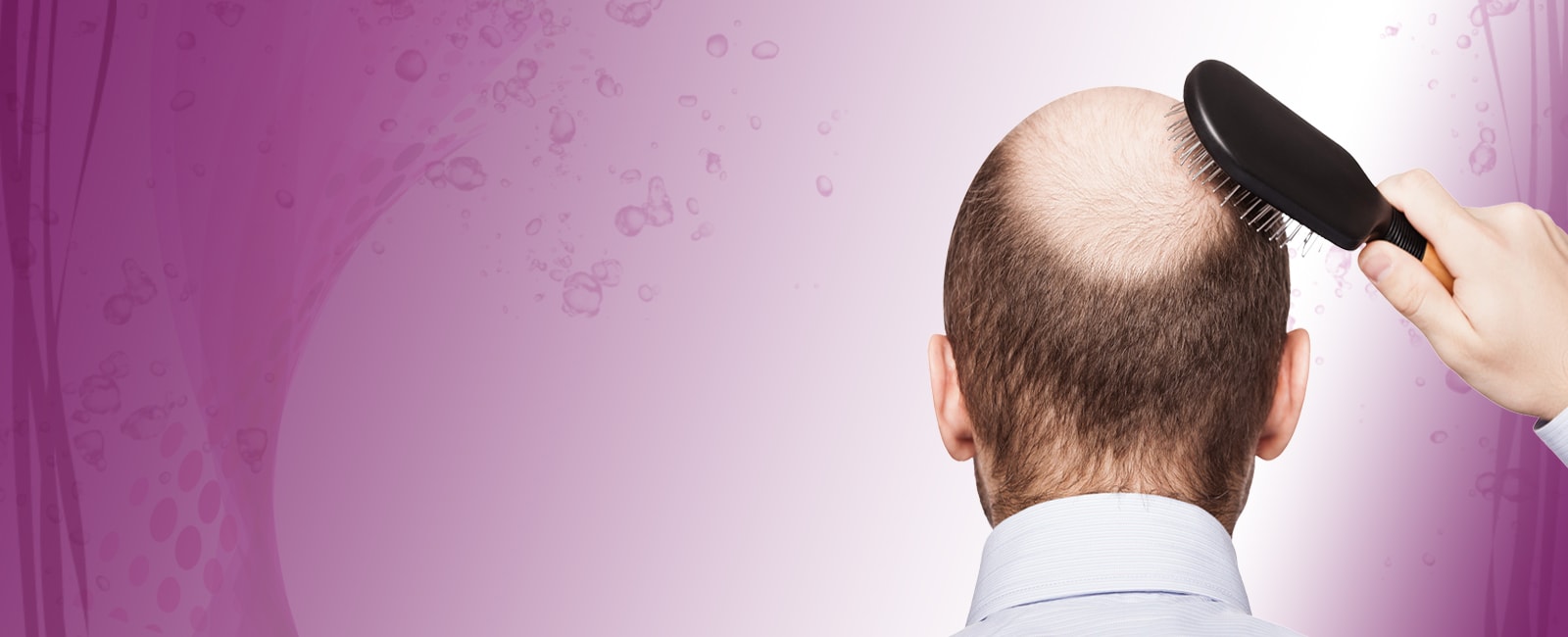 hair_transplantation